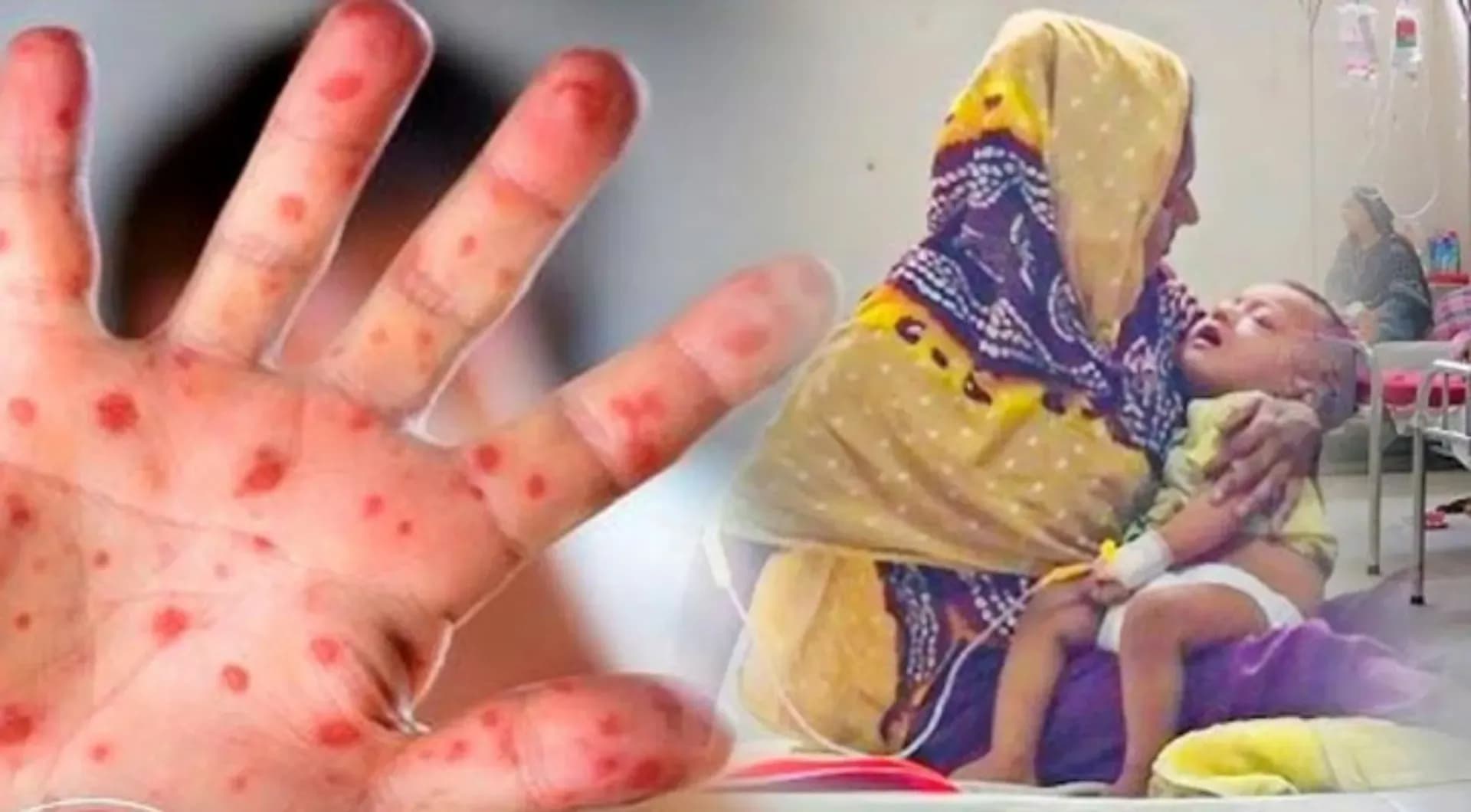 ২৪ ঘণ্টায় হাম ও উপসর্গে ৩ মৃত্যু, আক্রান্ত ১০৬৪