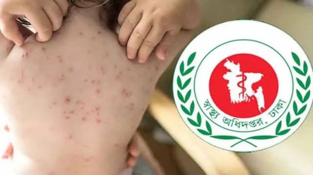 গত ২৪ ঘণ্টায় হামের উপসর্গে আরও ৭ শিশুর মৃত্যু