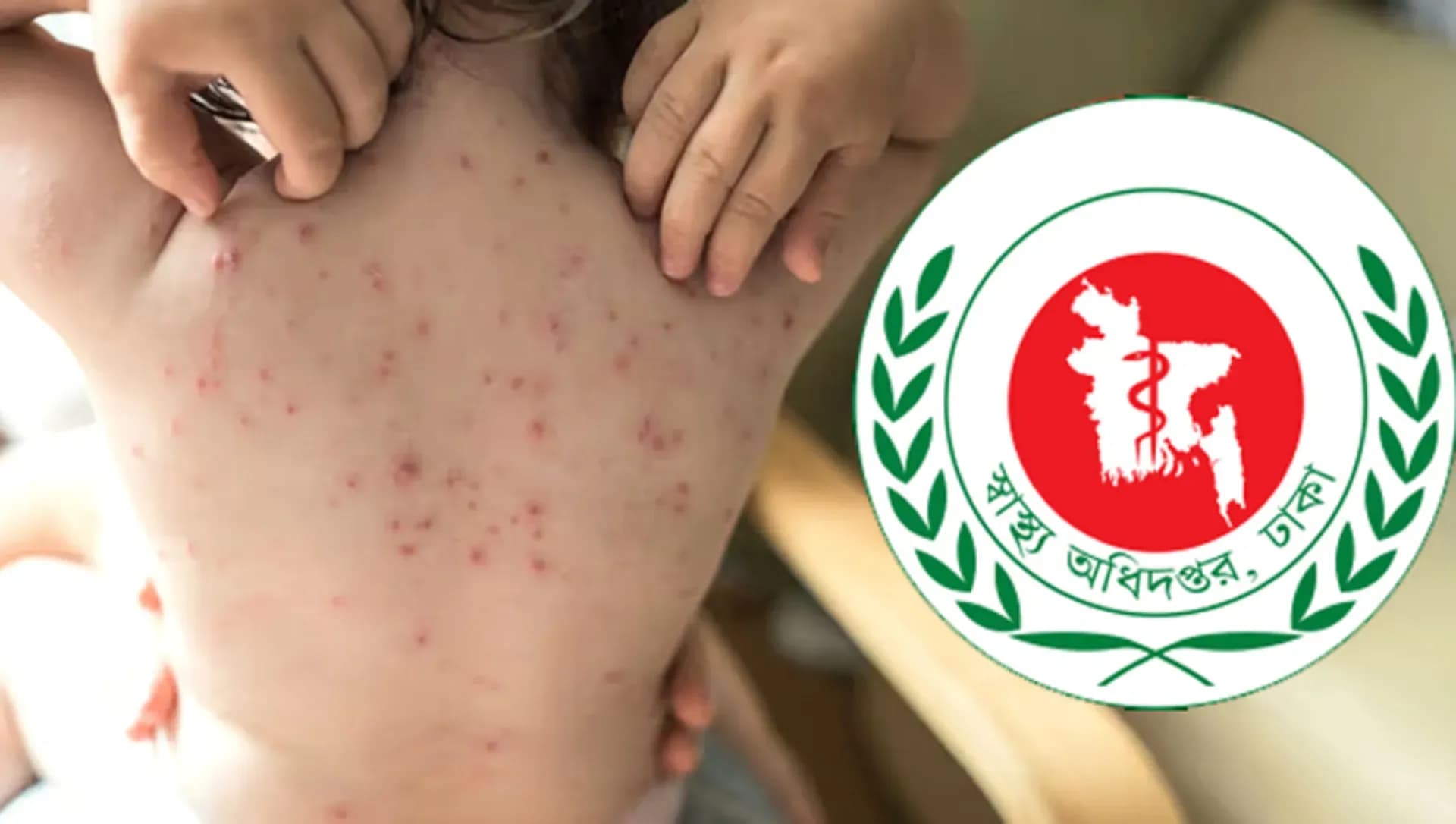 হাম ও উপসর্গে আরও ৩ জনের মৃত্যু